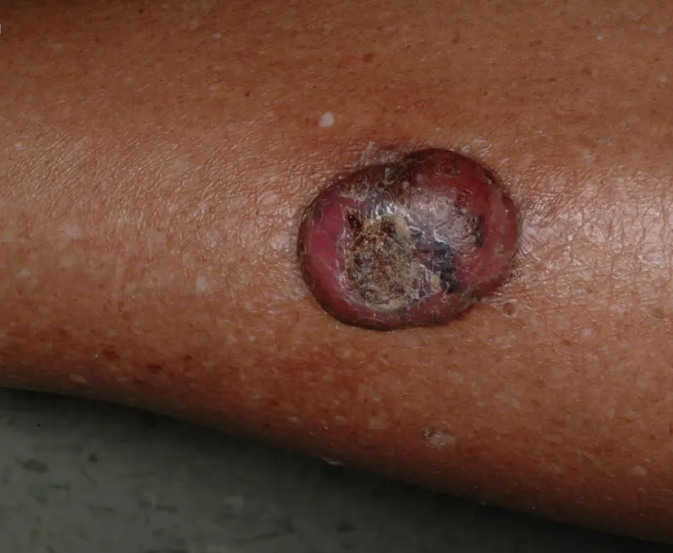 Darker skin tones have negligible risks associated with skin cancer.